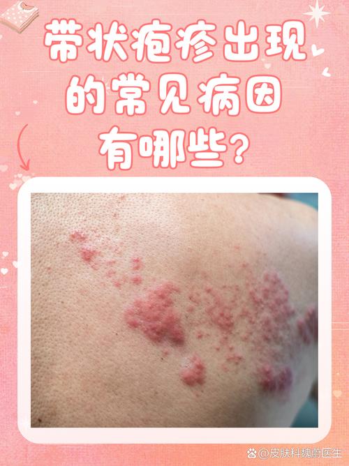 什么原因引起带状疱疹