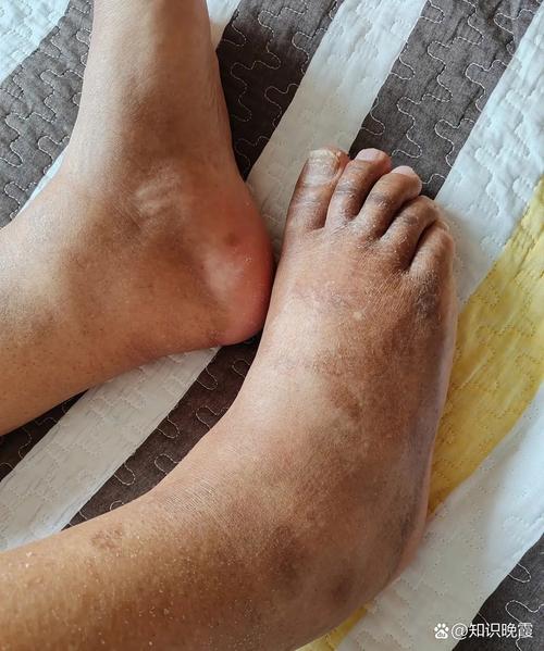 男人脚肿是什么病