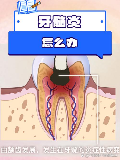 为什么会得牙髓炎