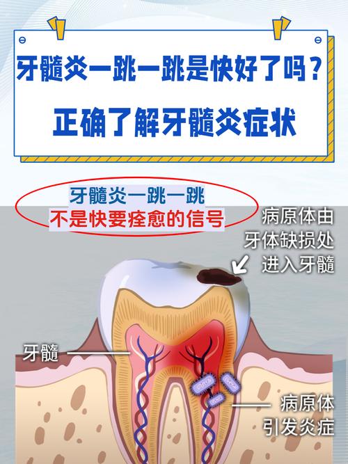 为什么会得牙髓炎
