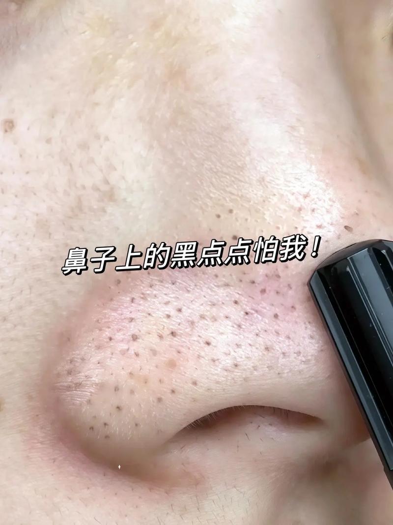 洗面奶脸过敏了怎么办