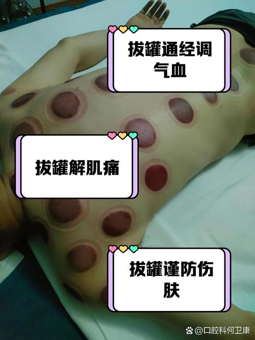 拔罐减肥连续三天有什么原因
