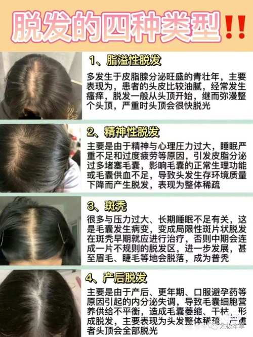 脱发厉害是什么原因
