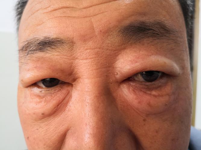 洗面奶过敏了怎么办