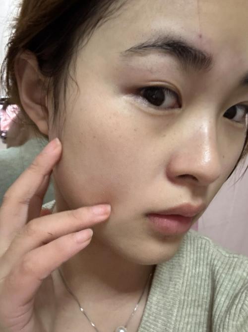 用了洗面奶皮肤有点刺痛是怎么回事呢