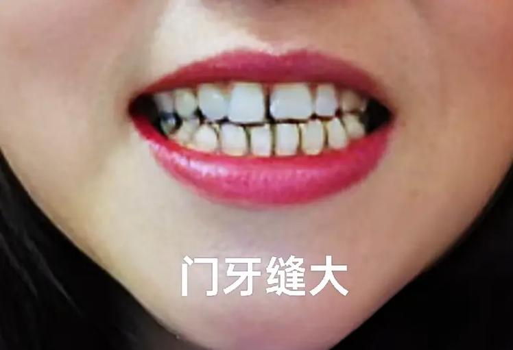 门牙有缝代表什么