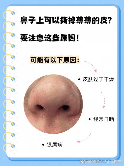 为什么鼻子老出油
