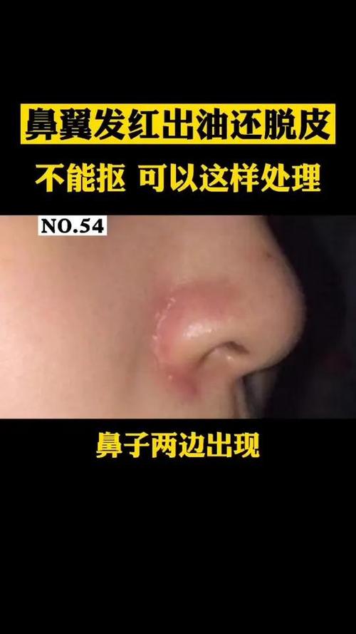 为什么鼻子老出油