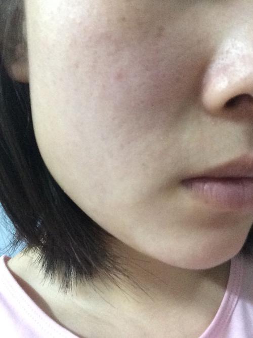 用完洗面奶脸部发红是怎么回事