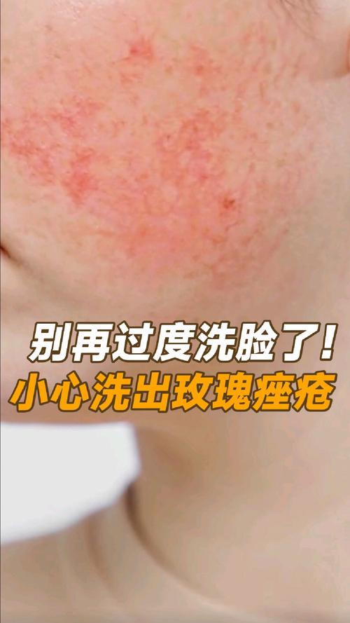 脸上用了玫瑰洗面奶过敏怎么办