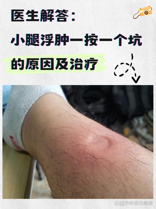 腿水肿是什么