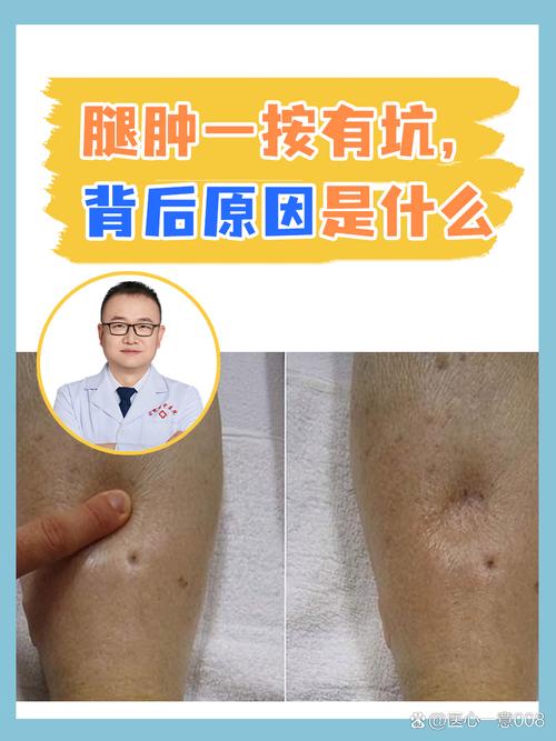 腿水肿是什么