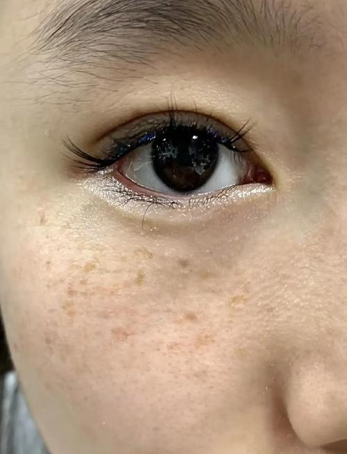 最新睡眠祛斑是什么