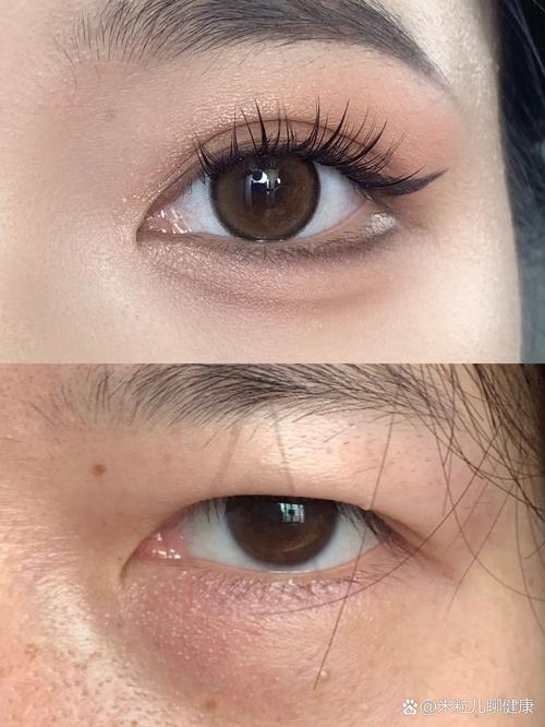 泡眼是什么