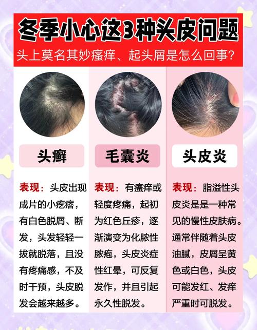 头上长癣是什么原因