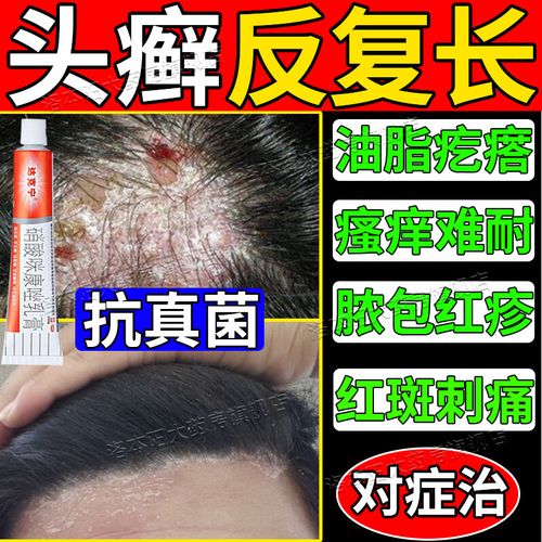 头上长癣是什么原因