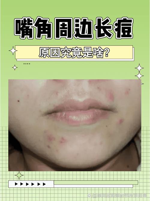 嘴上长痘是什么原因