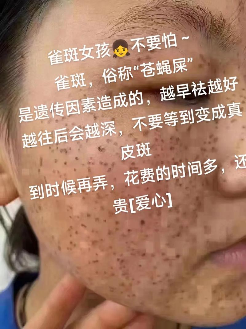 最新祛雀斑方法是什么