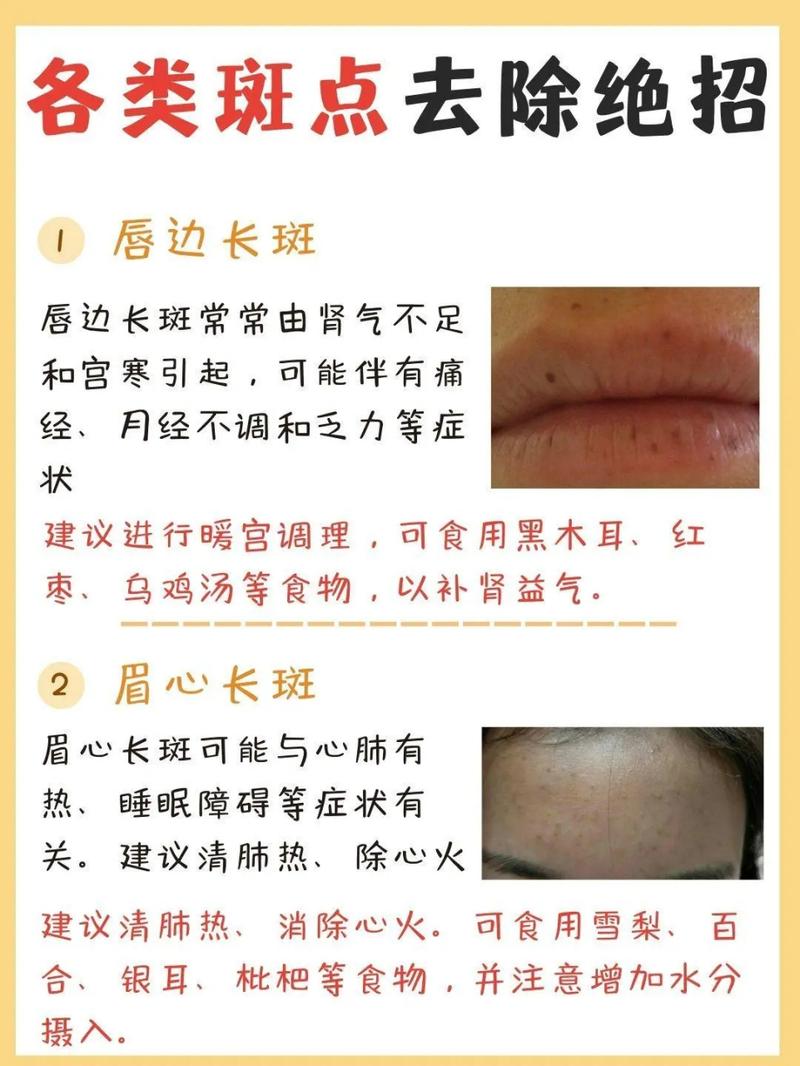 最新祛雀斑方法是什么