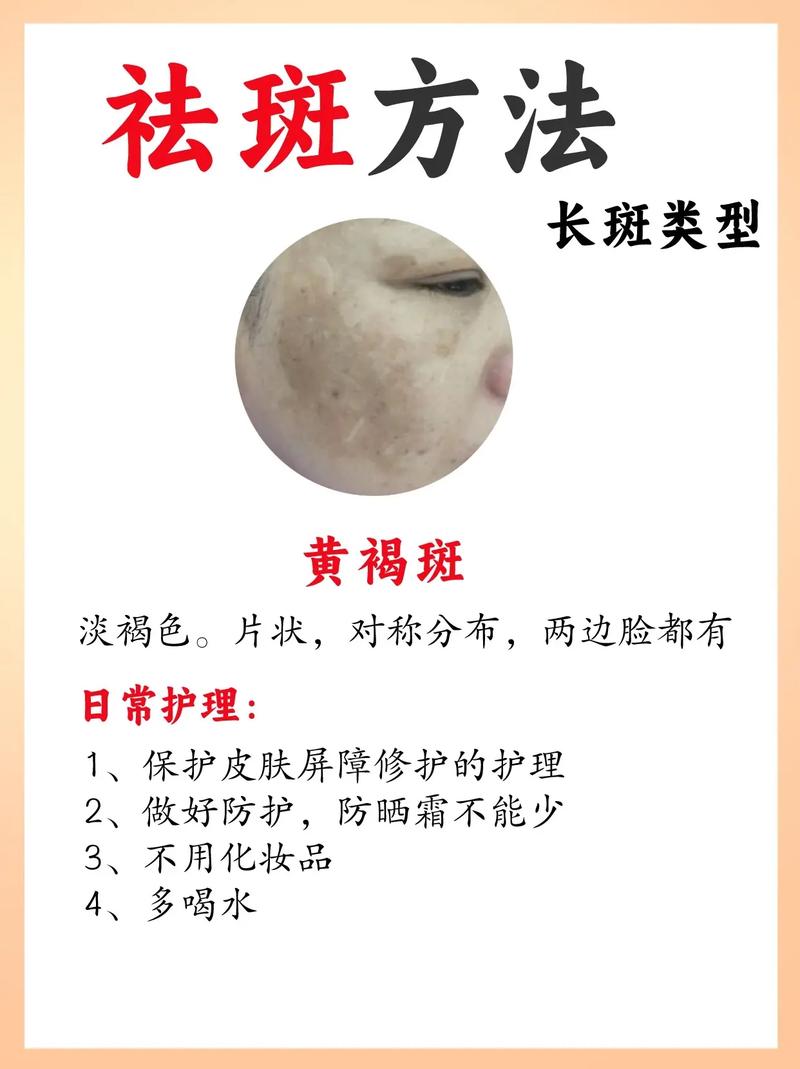 用什么方法能祛斑