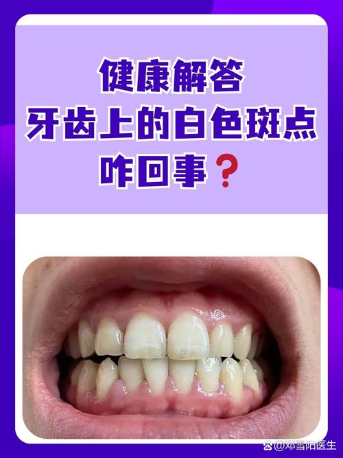 牙齿上白白的是什么