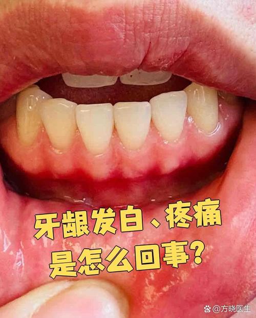 牙齿上白白的是什么