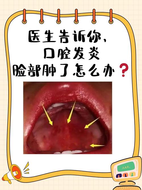 口腔肿痛是什么原因