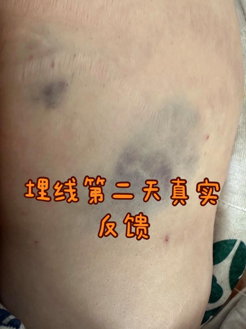 埋线减肥后会有什么反应