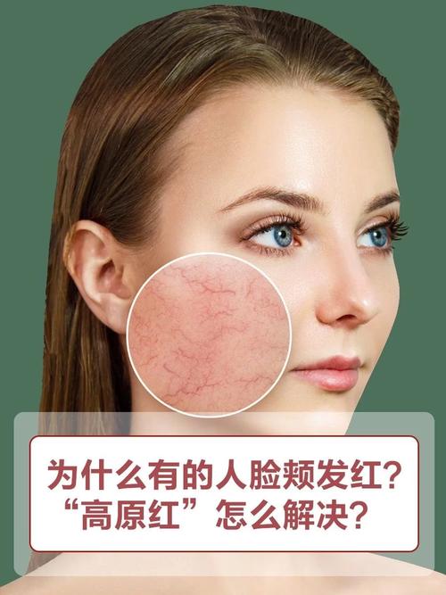 高原红是什么原因