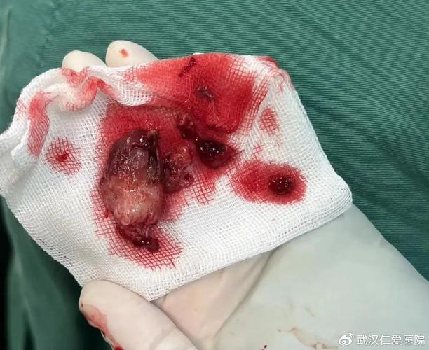 子宫肌瘤最新什么手术