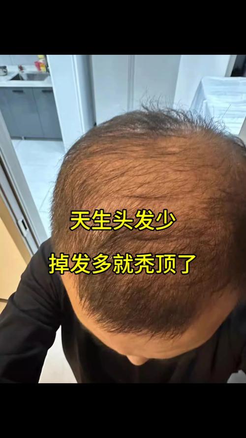 为什么头发越长越少