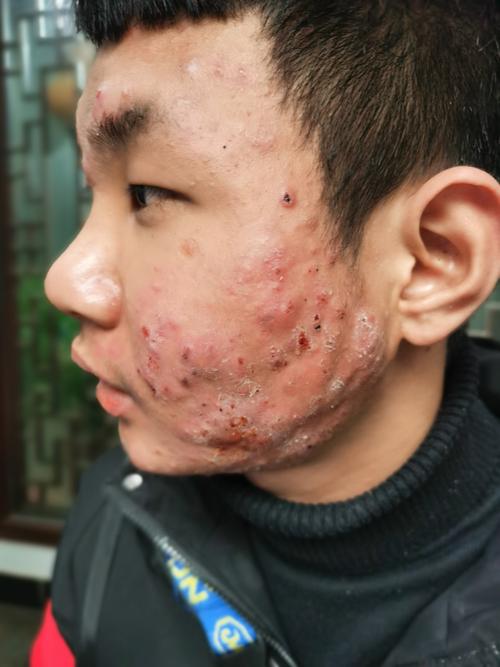 脸上为什么会长脓包