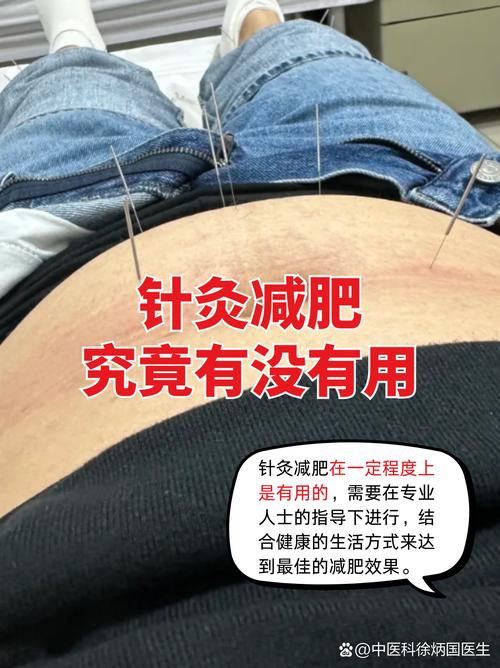 针灸减肥原理是什么