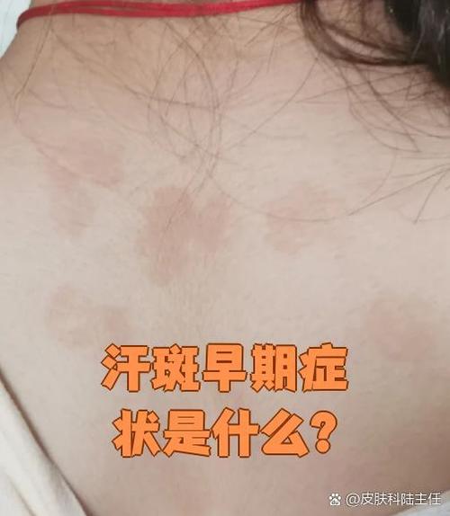 什么叫汗斑