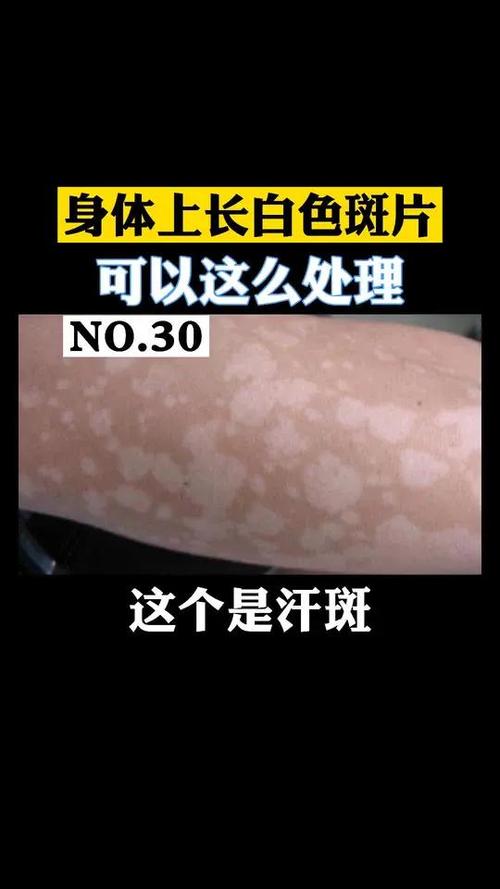 什么叫汗斑