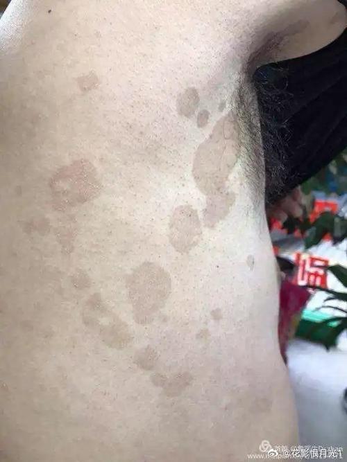 什么叫汗斑