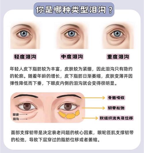 泪沟怎么办最新治疗