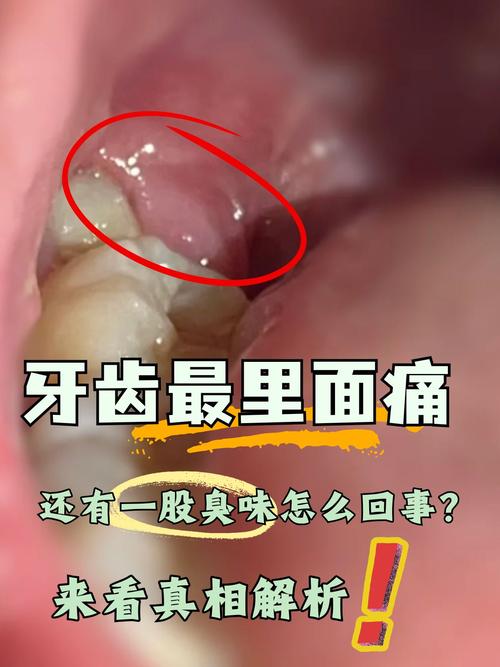 牙齿痛是什么问题