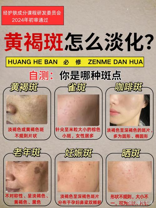最新祛斑方法是什么