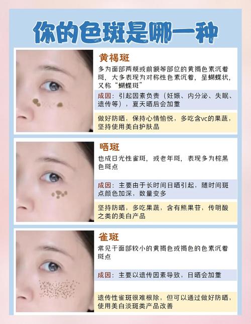 最新祛斑方法是什么