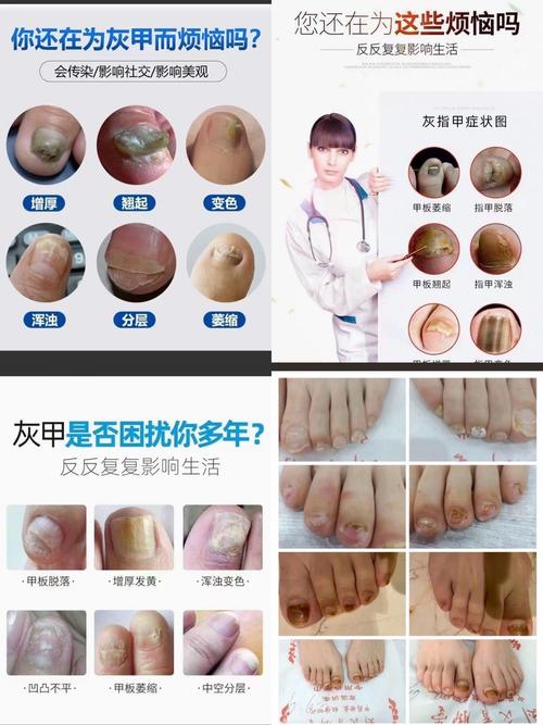 为什么会的灰指甲