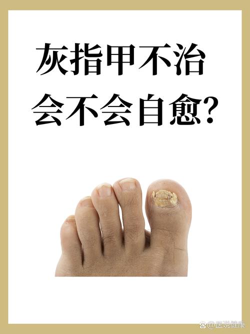 为什么会的灰指甲