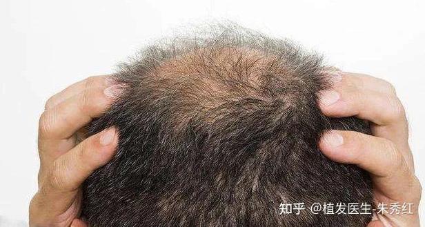 溢脂性脱发是什么