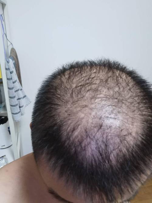 溢脂性脱发是什么
