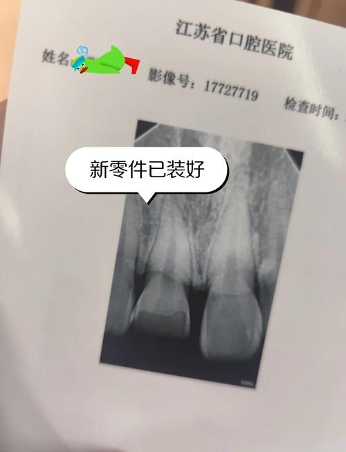 大门牙什么时候换