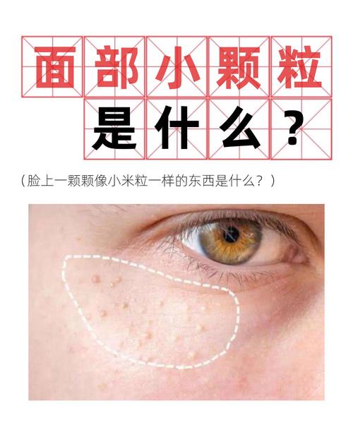 脸上白色的痘痘是什么