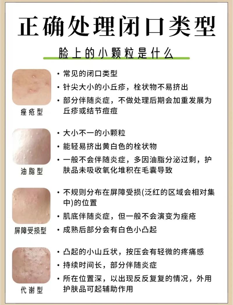 为什么会有闭口粉刺