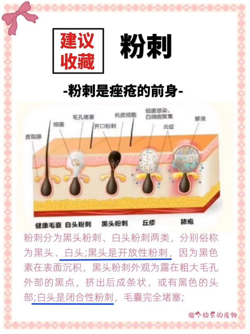 为什么会有闭口粉刺