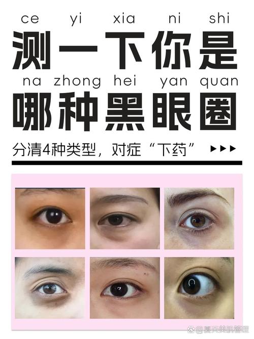黑眼圈是什么回事