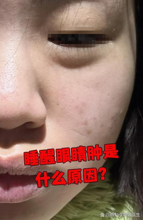 为什么熬夜脸会肿